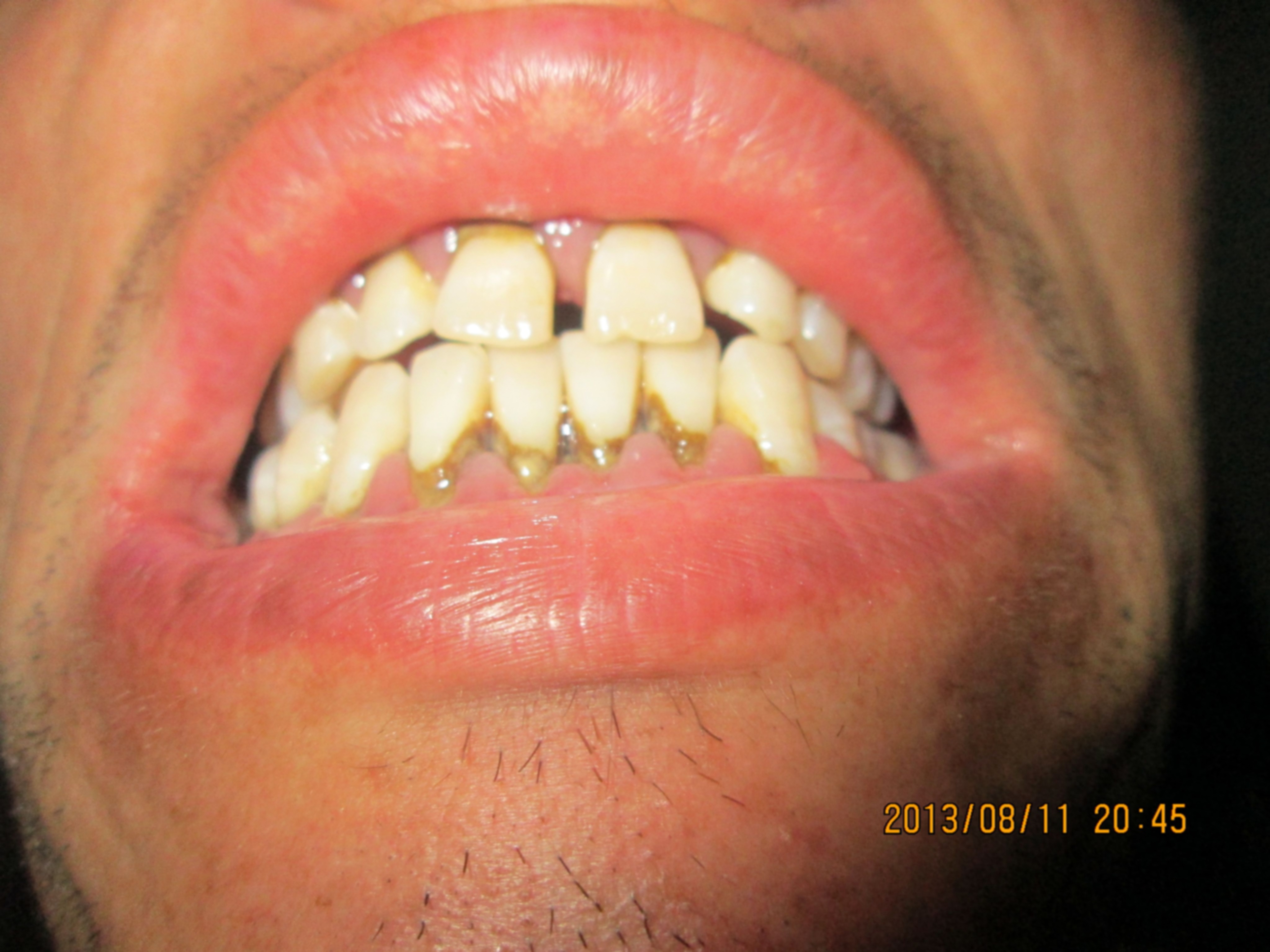 牙齿全部拔完后多久才能装假牙